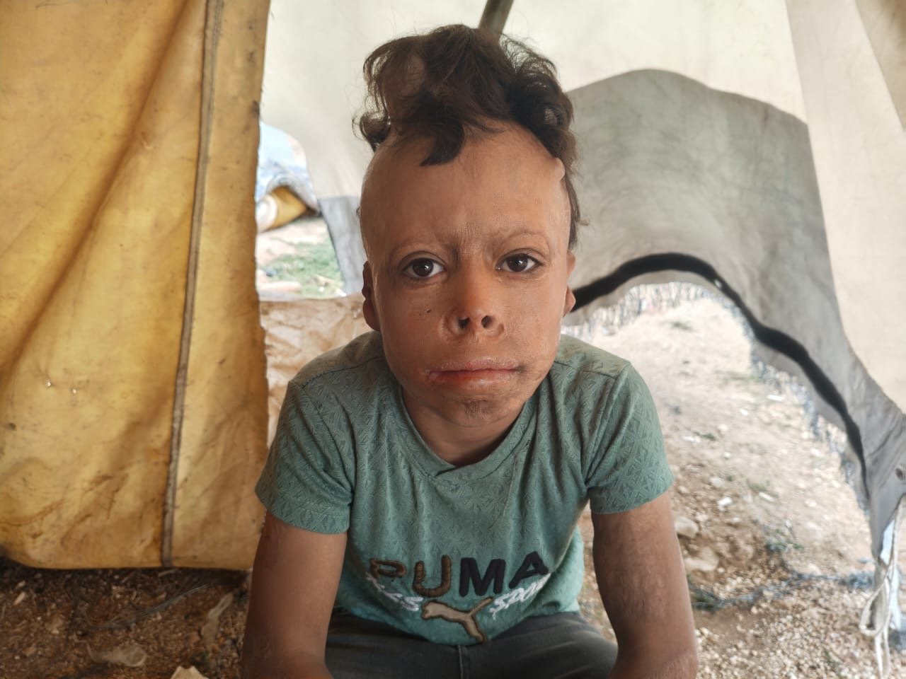 Help Little Ali Recover After Severe Burns 💔