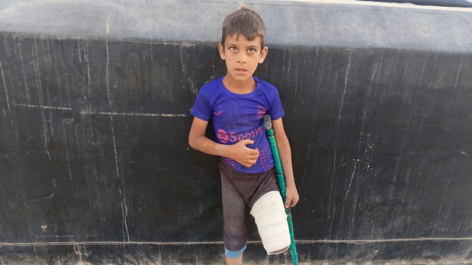 Ali’s Journey Beyond Amputation